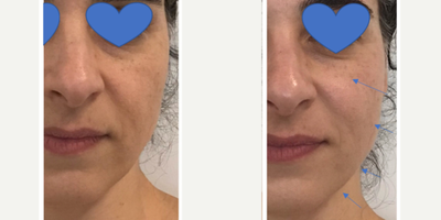 Exilis before and after photo