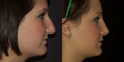 Rhinoplasty before and after photo