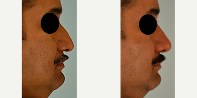 Rhinoplasty before and after photo