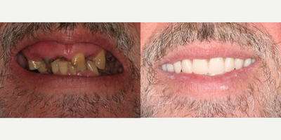 All-on-4 Dental Implants before and after photo