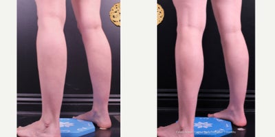 BodyTite before and after photo