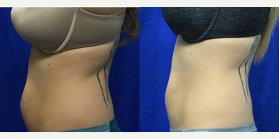 CoolSculpting before and after photo