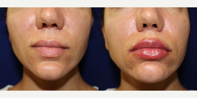 Dermal Fillers before and after photo