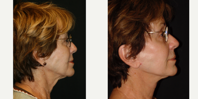 Facelift before and after photo