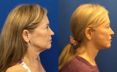 Facelift before and after photo