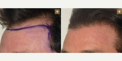 Hair Transplant before and after photo