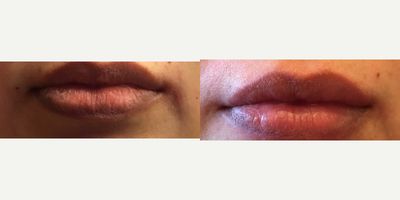 Juvederm before and after photo