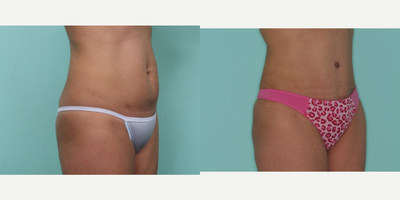 Tummy Tuck before and after photo