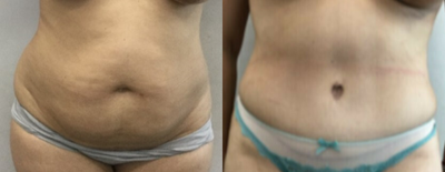 Tummy Tuck before and after photo