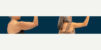 Arm Lift before and after photo