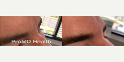 Botox before and after photo