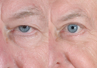 Eyelid Surgery before and after photo