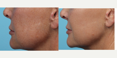 IPL before and after photo