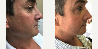 Kybella before and after photo