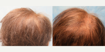 PRP for Hair Loss before and after photo