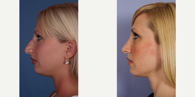 Rhinoplasty before and after photo