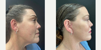 Facelift before and after photo