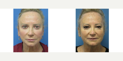 Facelift before and after photo