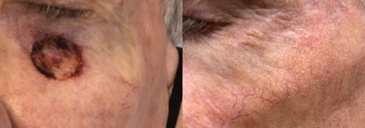 Mohs Surgery before and after photo