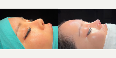 Revision Rhinoplasty before and after photo