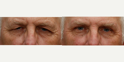 Brow Lift before and after photo