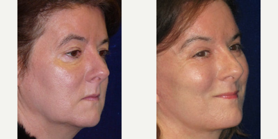 Brow Lift before and after photo