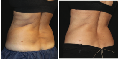 CoolSculpting before and after photo