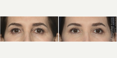 Facial Fat Transfer before and after photo