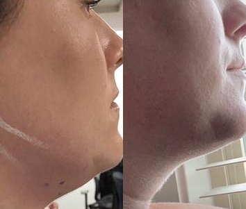 Kybella before and after photo