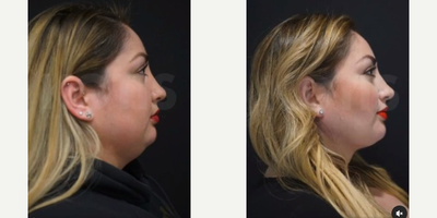 Liposuction before and after photo