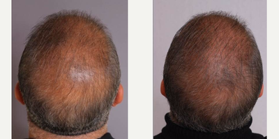 PRP for Hair Loss before and after photo