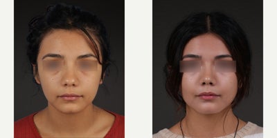 Rhinoplasty before and after photo