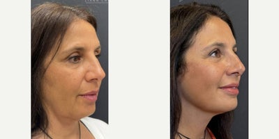 Facelift before and after photo