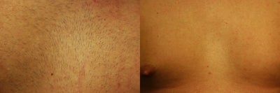 Laser Hair Removal before and after photo