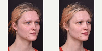 Lip Fillers before and after photo