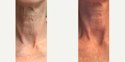 Thread Lift before and after photo