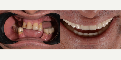 All-on-4 Dental Implants before and after photo