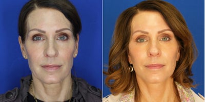 Deep Plane Facelift before and after photo