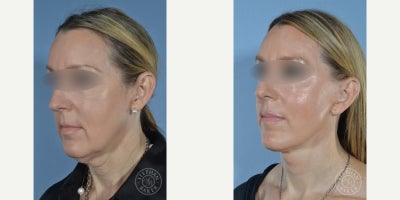Facelift before and after photo