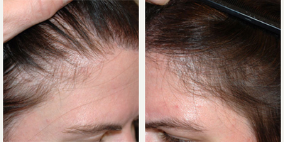Hair Loss Treatment before and after photo