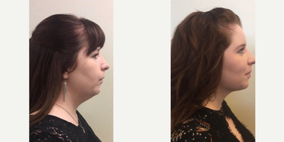 Kybella before and after photo
