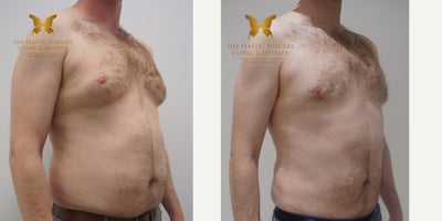 Breast Reduction before and after photo
