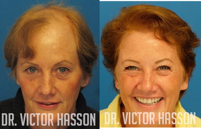 FUE Hair Transplant before and after photo
