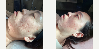 Laser Resurfacing before and after photo