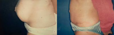Tummy Tuck before and after photo