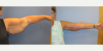Arm Lift before and after photo