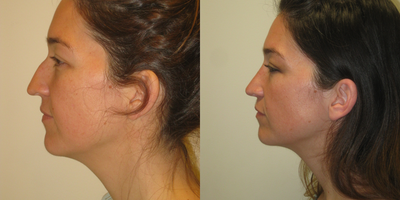 Asian Rhinoplasty before and after photo
