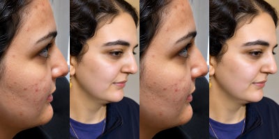 CO2 Laser before and after photo