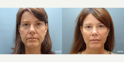 Dermal Fillers before and after photo