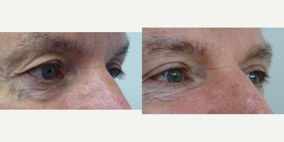 Eyelid Surgery before and after photo